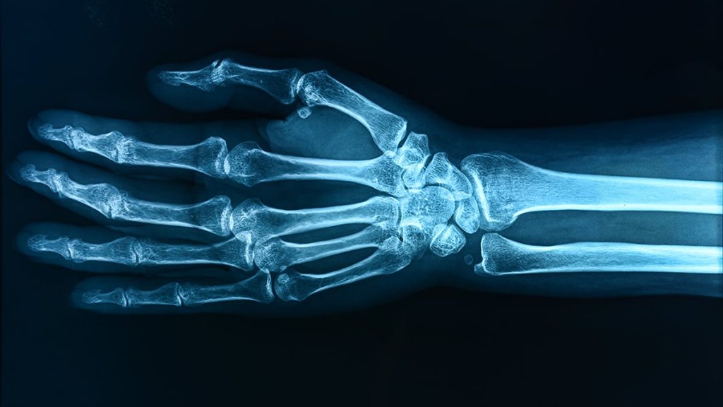 ‘Forever Chemicals’ May Be Weakening The Bones of Children, Study Warns : ScienceAlert