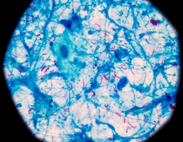 Progress and gaps shape India’s tuberculosis control strategy
