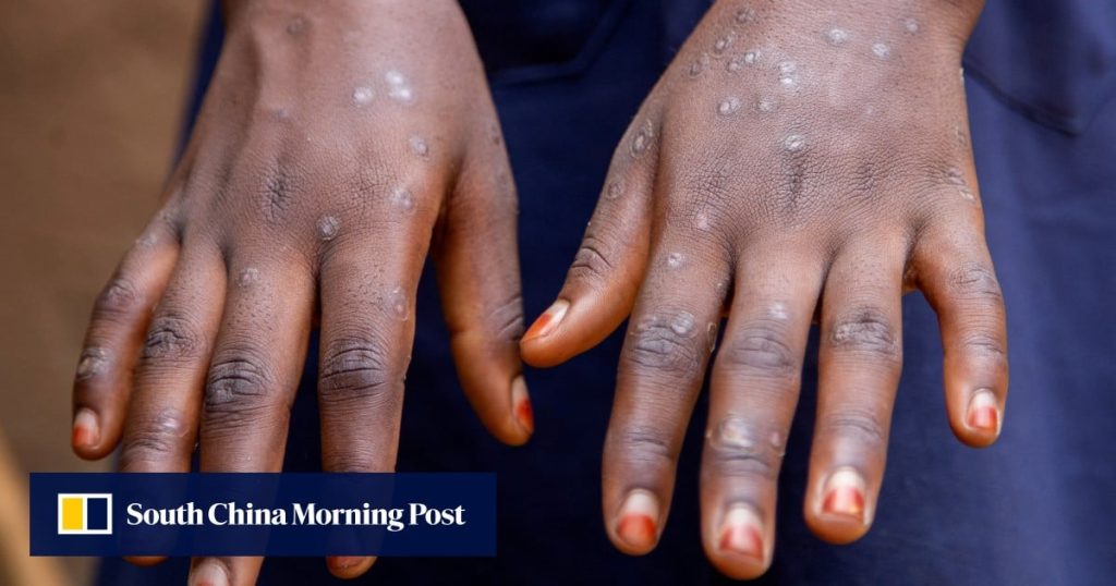5 Mpox cases linked to Hong Kong ‘premier’ gay sauna, contact tracing under way