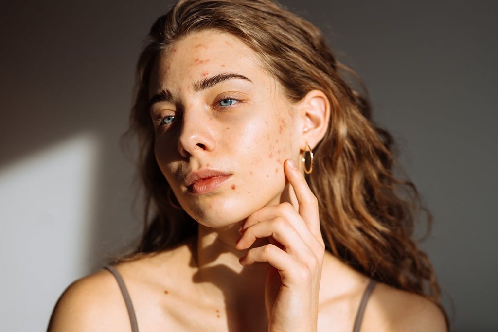 Heat Rash vs Acne in UAE Summers: Dermatologists Reveal Causes, Common Mistakes and Simple Skincare Routine