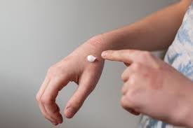 Lynk Pharmaceuticals Doses First Patient in Phase II Trial of Novel Vitiligo Therapy